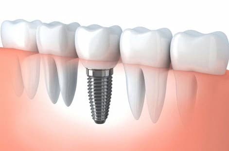 Dental Implants