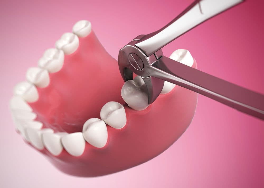 Wisdom Tooth Extraction