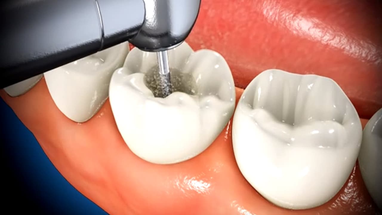 Root Canal Rx