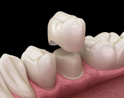 Ceramic Teeth