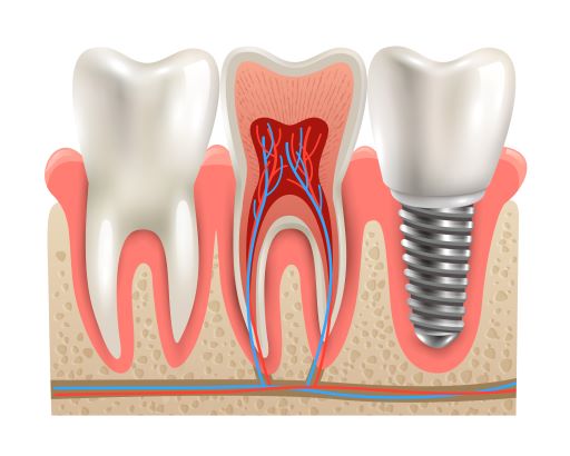 Implants