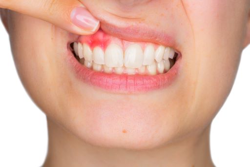 Bleeding Gums